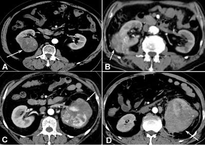 Comparison of Different Machine Models Based on <mark class="highlighted">Contrast-Enhanced Computed Tomography</mark> Radiomic Features to Differentiate High From Low Grade Clear Cell Renal Cell Carcinomas
